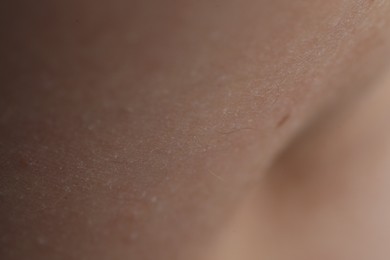 Photo of Texture of dry skin as background, closeup