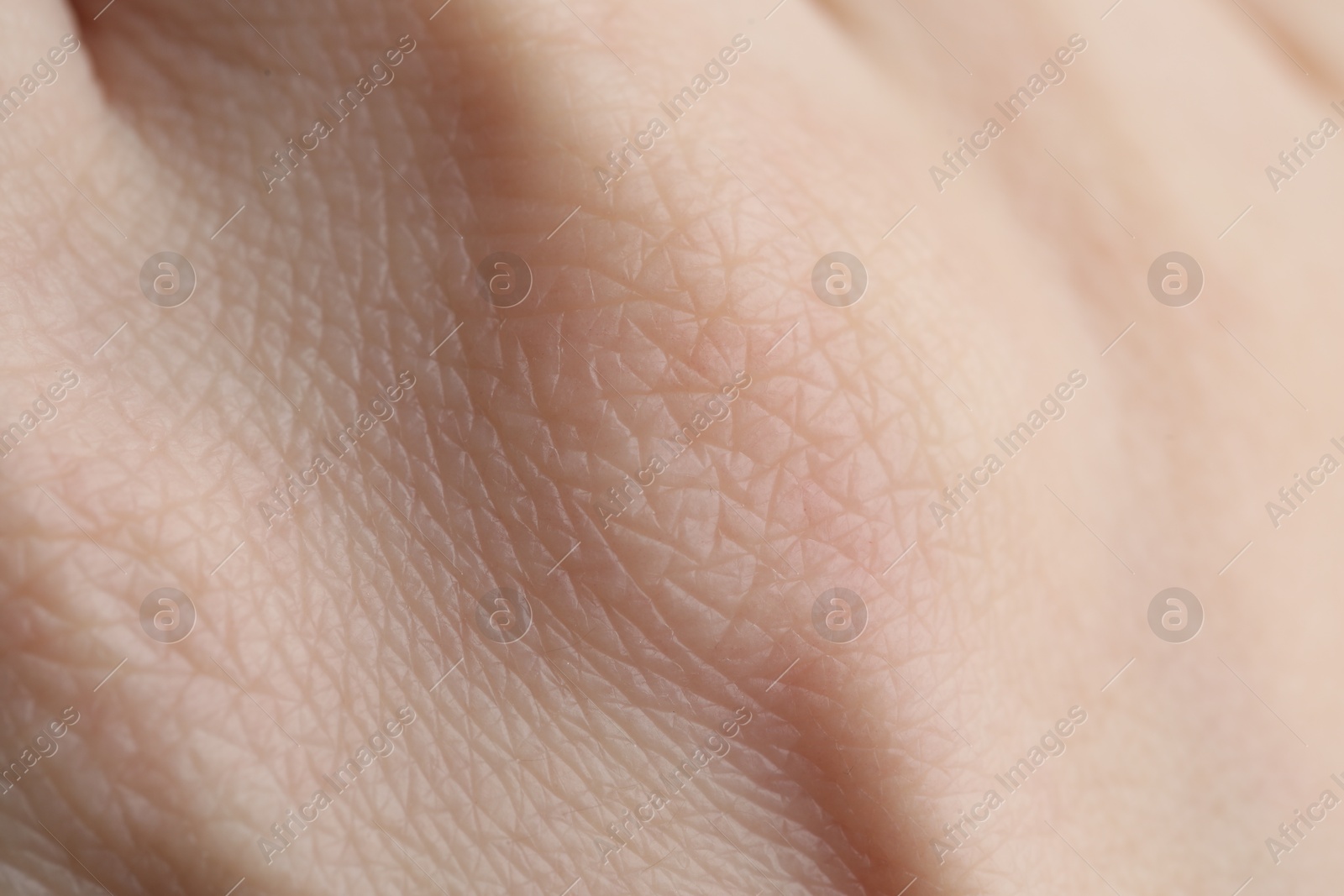 Photo of Texture of dry skin as background, closeup