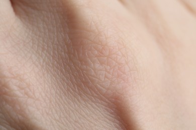 Photo of Texture of dry skin as background, closeup