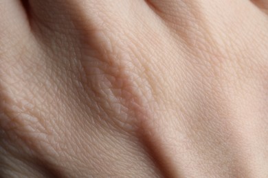 Photo of Texture of dry skin as background, closeup