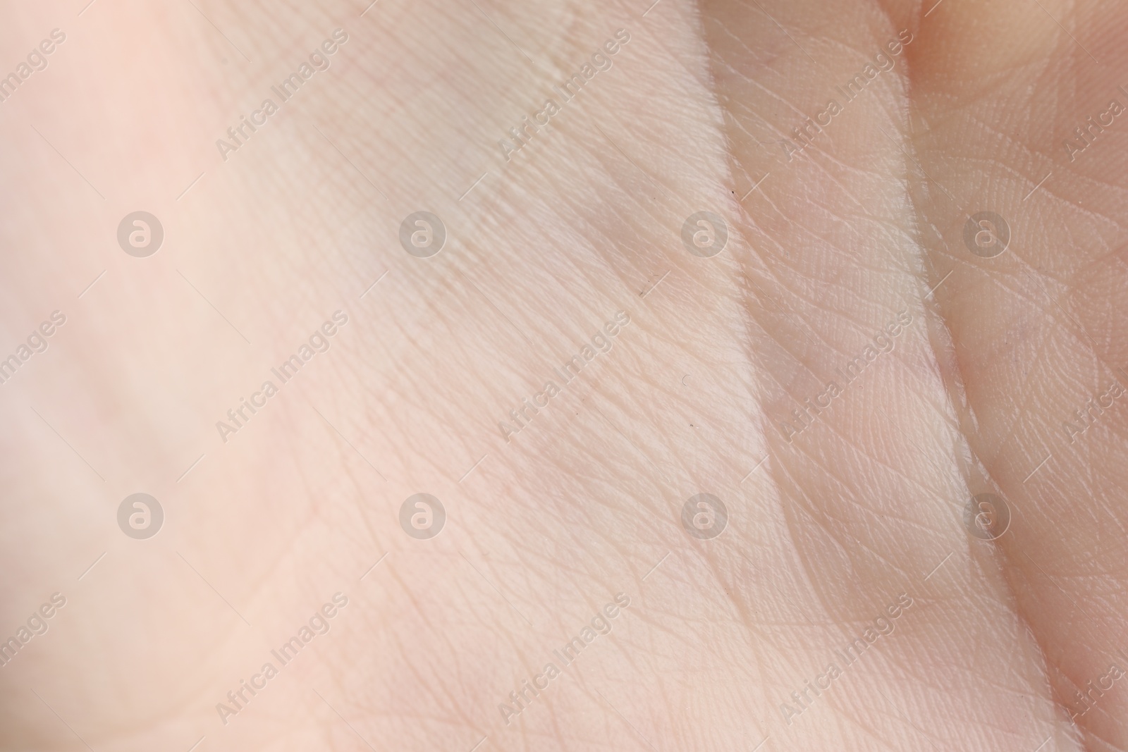 Photo of Texture of dry skin as background, closeup