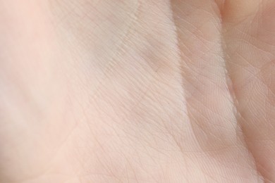 Photo of Texture of dry skin as background, closeup