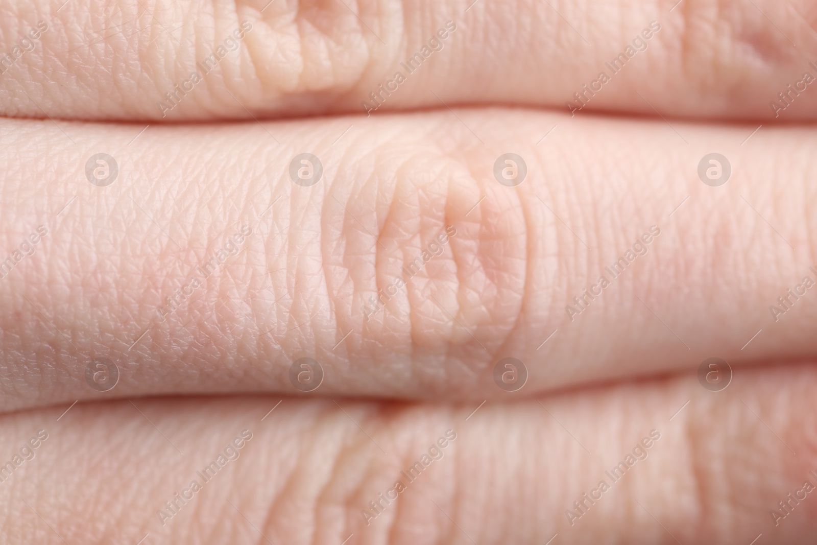 Photo of Texture of dry skin as background, closeup