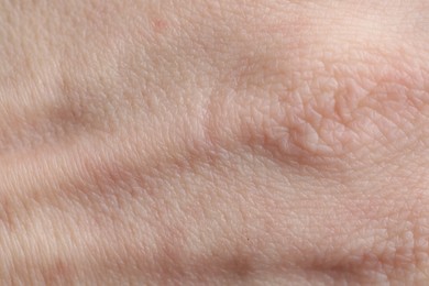 Photo of Texture of dry skin as background, closeup