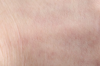 Photo of Texture of dry skin as background, closeup