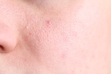 Photo of Texture of skin with enlarged pores as background, closeup