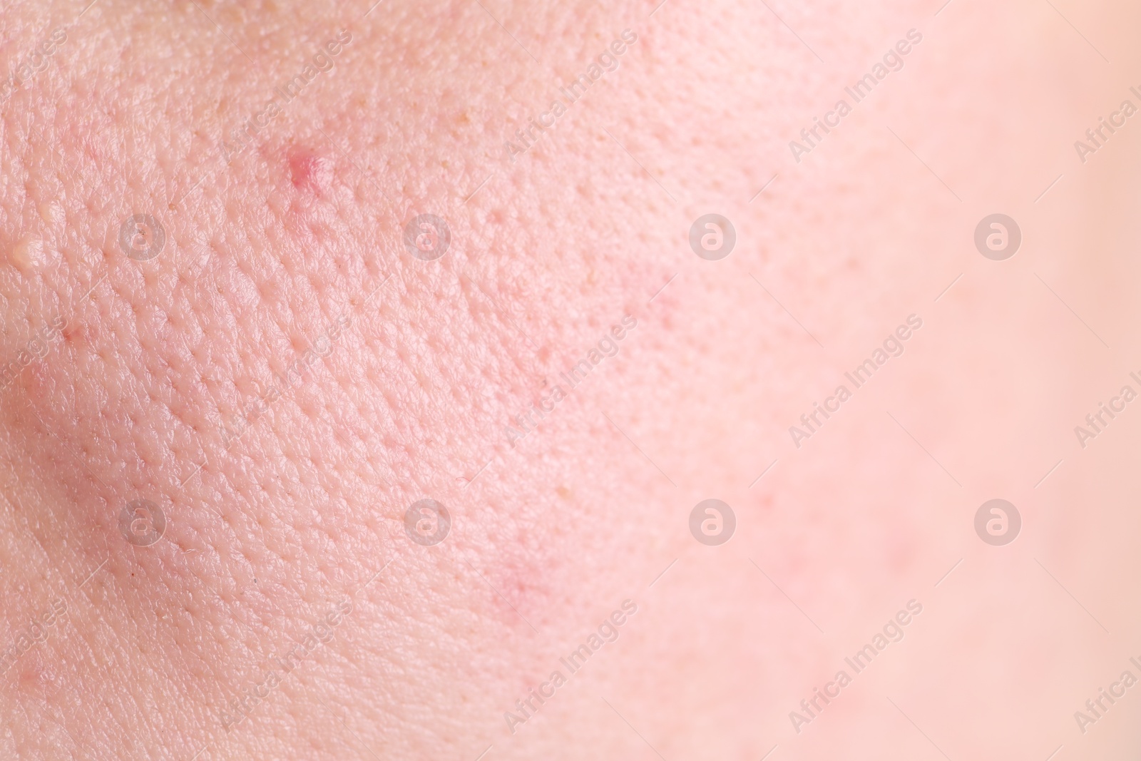 Photo of Texture of skin with enlarged pores as background, closeup