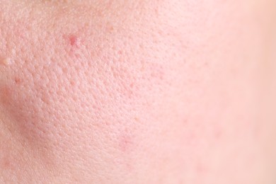 Photo of Texture of skin with enlarged pores as background, closeup