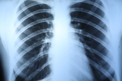 Photo of X-ray image of ribcage as background, closeup