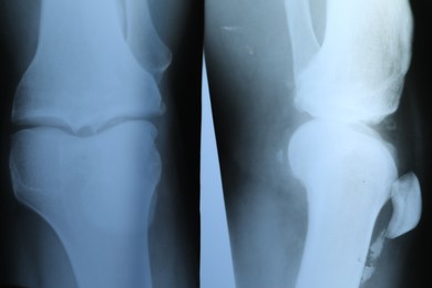 Photo of X-ray image of knee joint as background, closeup