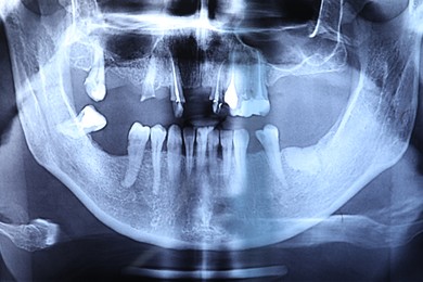 Photo of X-ray image of jaws as background, closeup