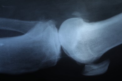 Photo of X-ray image of knee joint as background, closeup