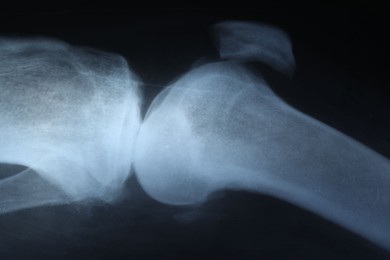 Photo of X-ray image of knee joint as background, closeup