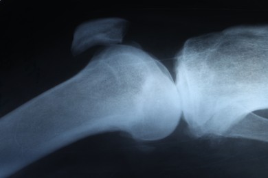 Photo of X-ray image of knee joint as background, closeup