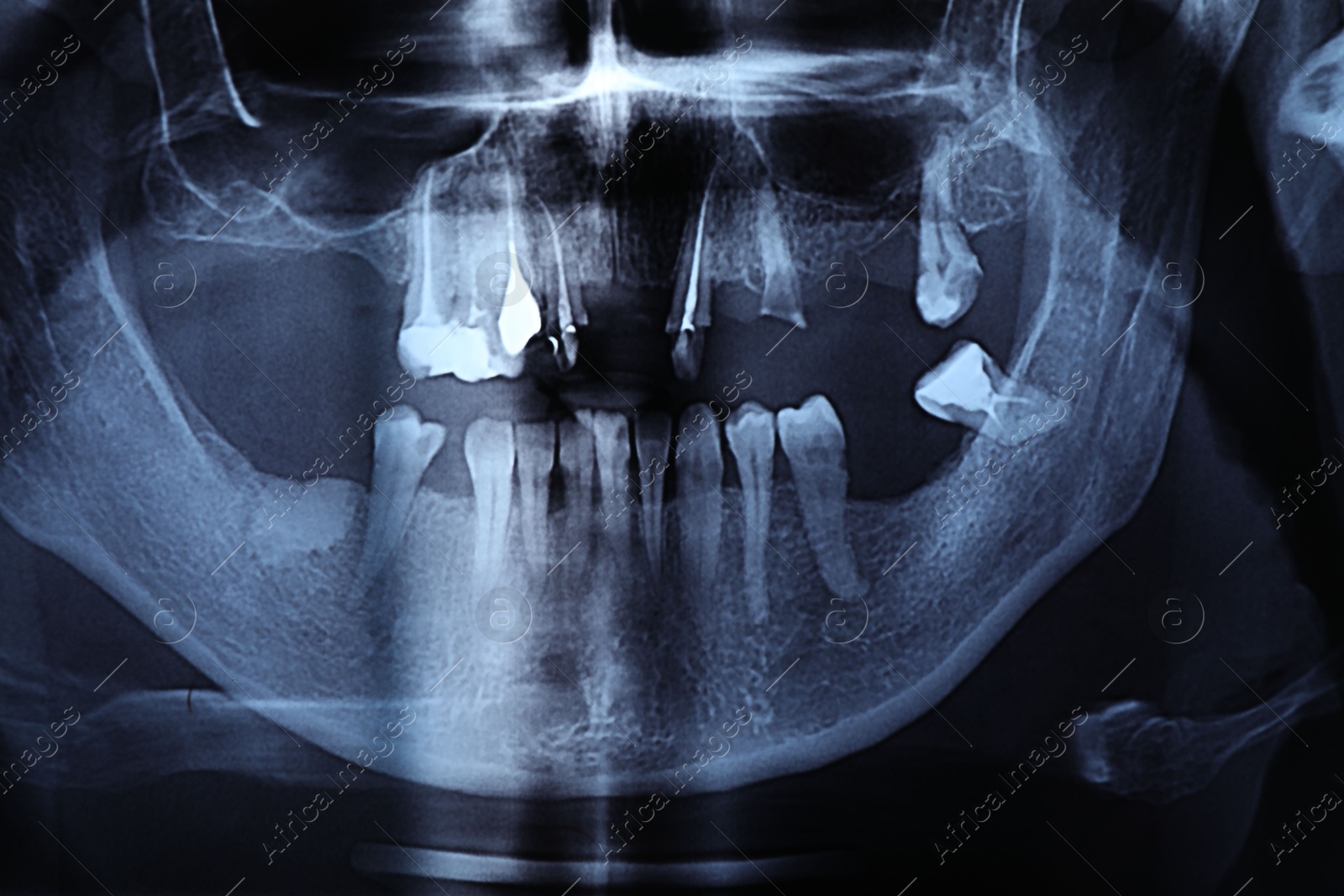 Photo of X-ray image of jaws as background, closeup