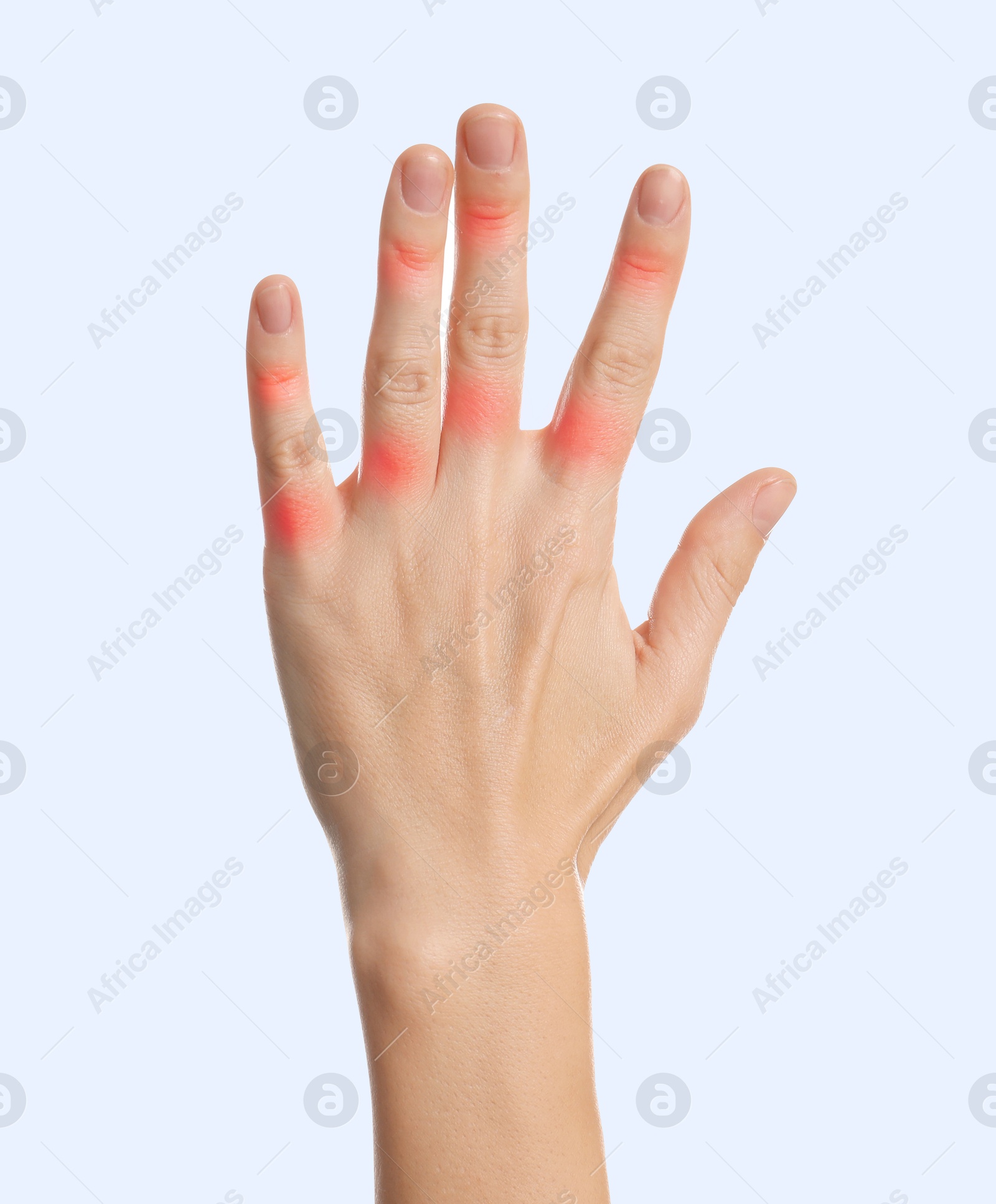 Image of Woman with joint inflammation on white background, closeup. Red areas on fingers