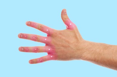 Image of Man with joint inflammation on light blue background, closeup. Highlighted areas on fingers