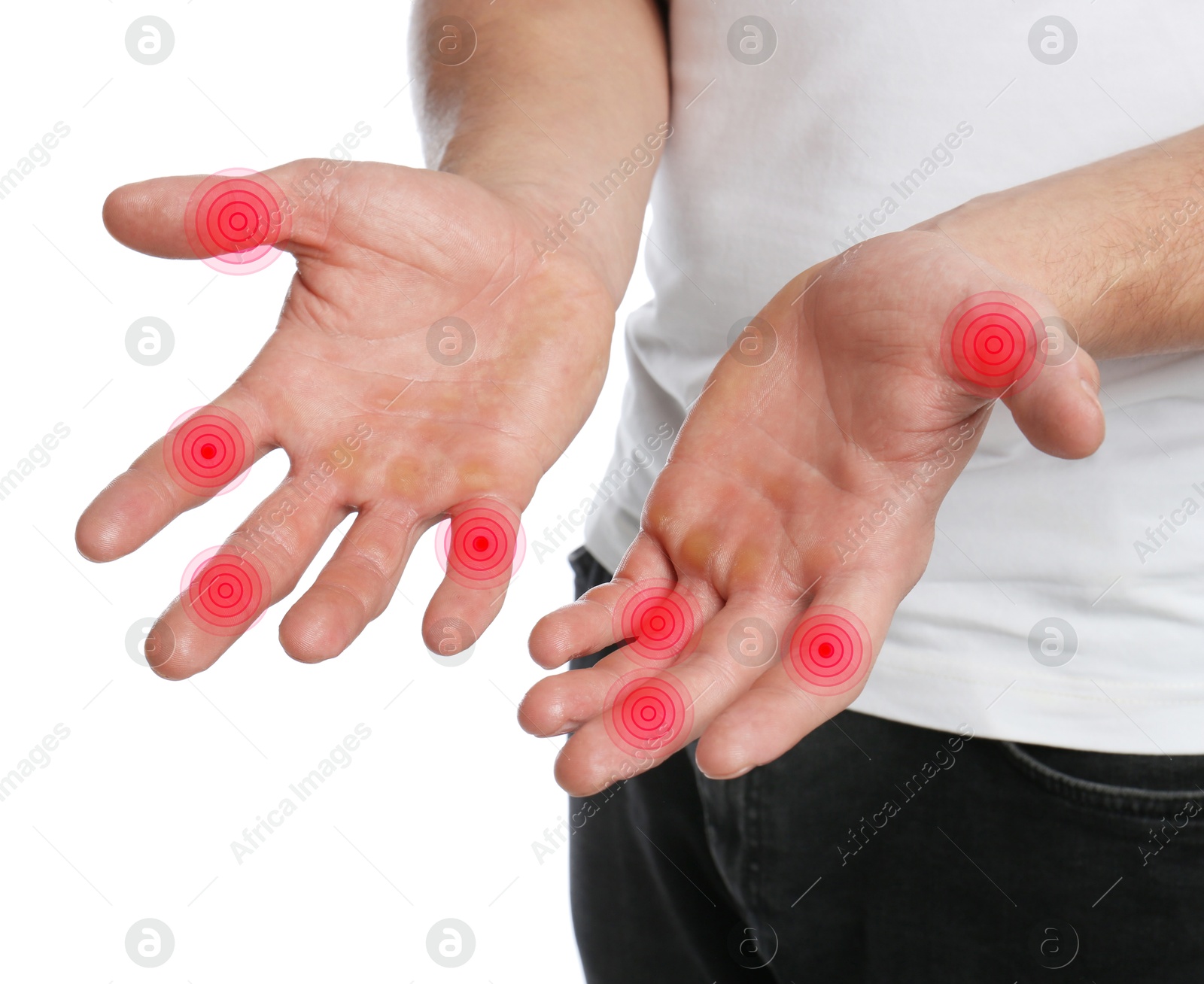 Image of Man with joint inflammation on white background, closeup. Red areas on fingers