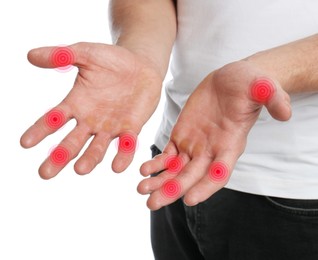 Image of Man with joint inflammation on white background, closeup. Red areas on fingers