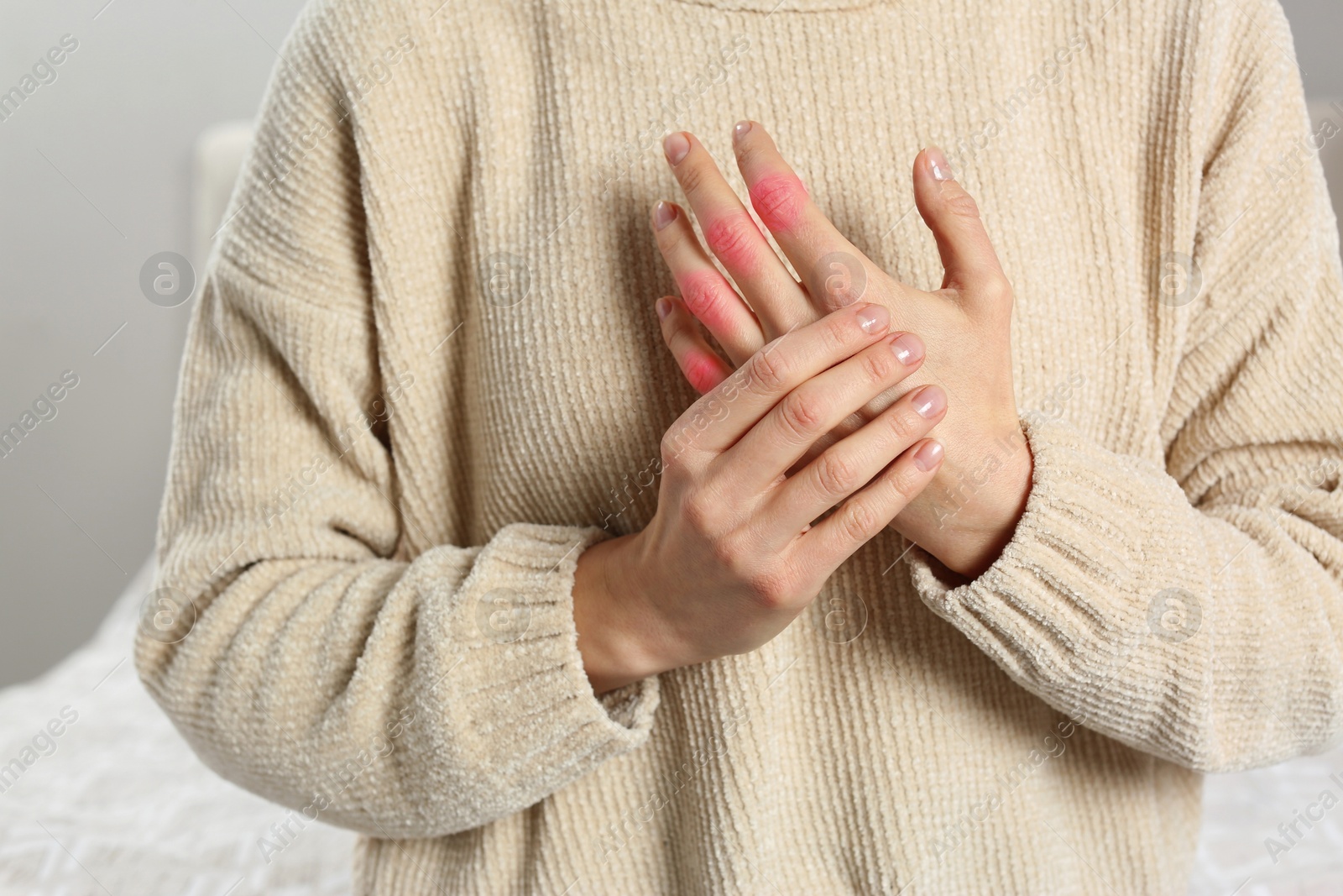 Image of Woman with joint inflammation indoors, closeup. Red areas on fingers