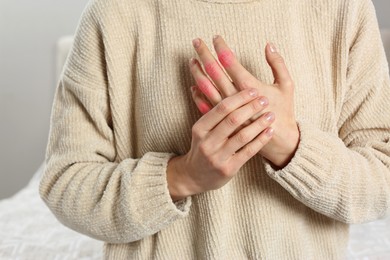 Image of Woman with joint inflammation indoors, closeup. Red areas on fingers