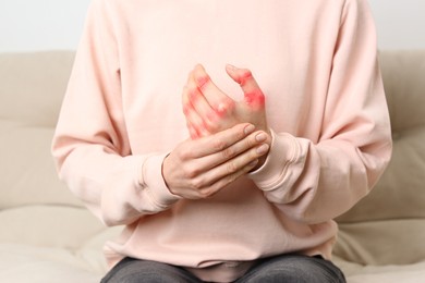 Image of Woman with joint inflammation indoors, closeup. Red areas on fingers