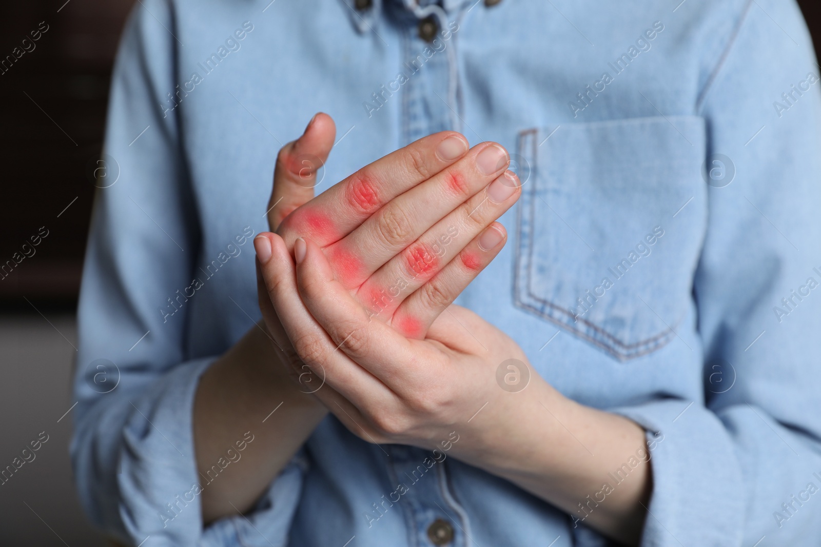 Image of Woman with joint inflammation indoors, closeup. Red areas on fingers