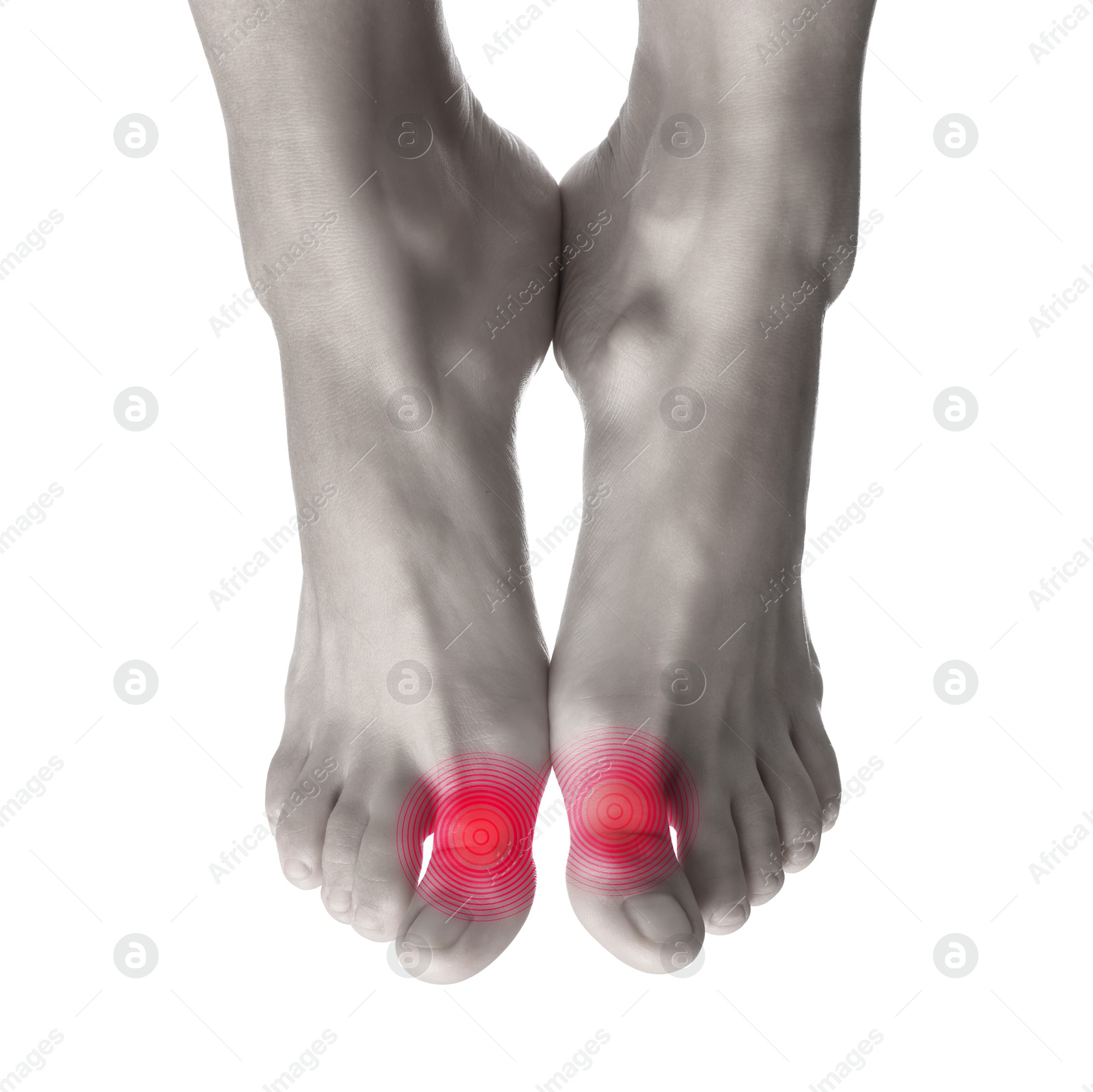 Image of Woman with joint inflammation on white background, closeup. Toned in black-and-white with color areas on toes