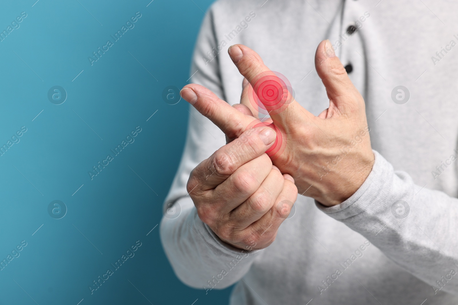 Image of Man with joint inflammation on light blue background, closeup. Red areas on fingers