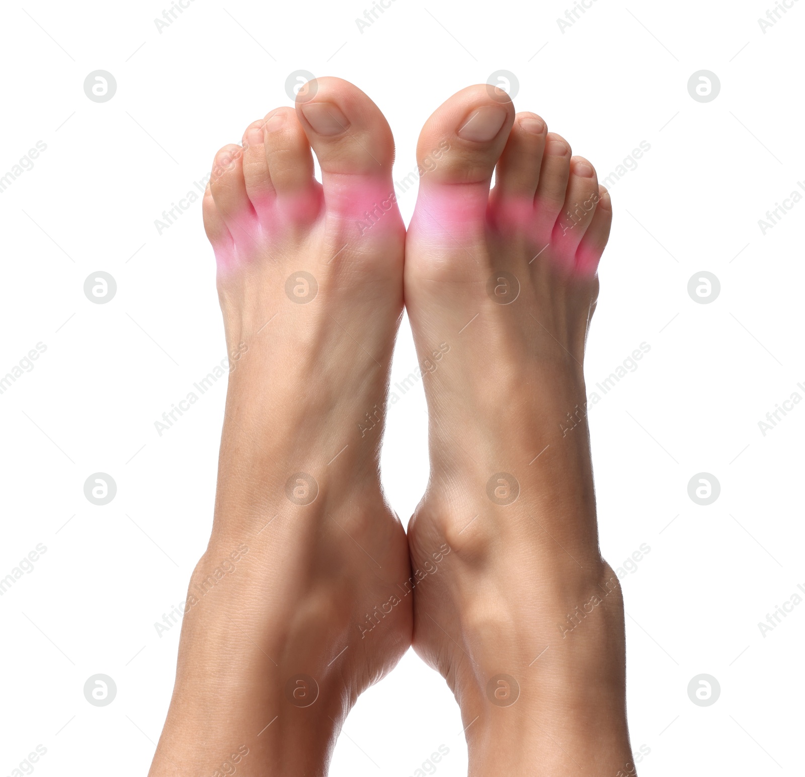 Image of Woman with joint inflammation on white background, closeup. Highlighted areas on toes