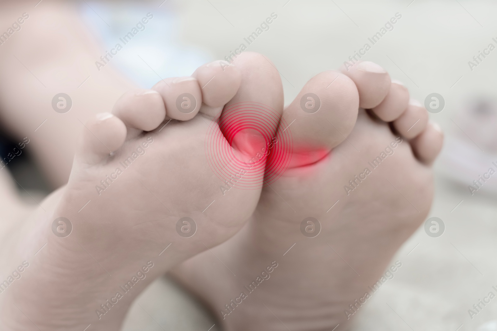 Image of Woman with joint inflammation, closeup. Highlighted areas on toes