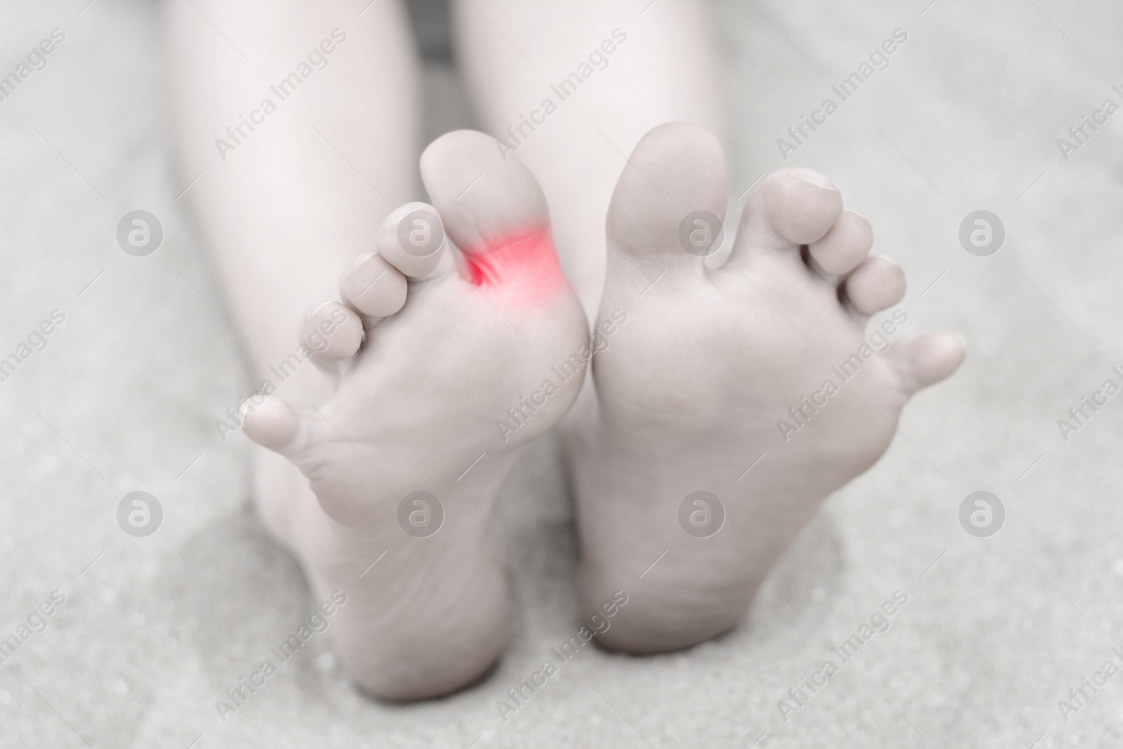 Image of Woman with joint inflammation, closeup. Highlighted area on toe. Toned in black-and-white with color area on toe