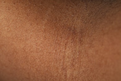 Photo of Macro view of normal skin as background