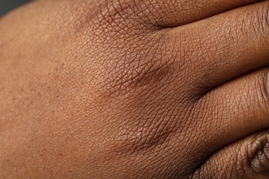 Photo of Macro view of normal skin as background