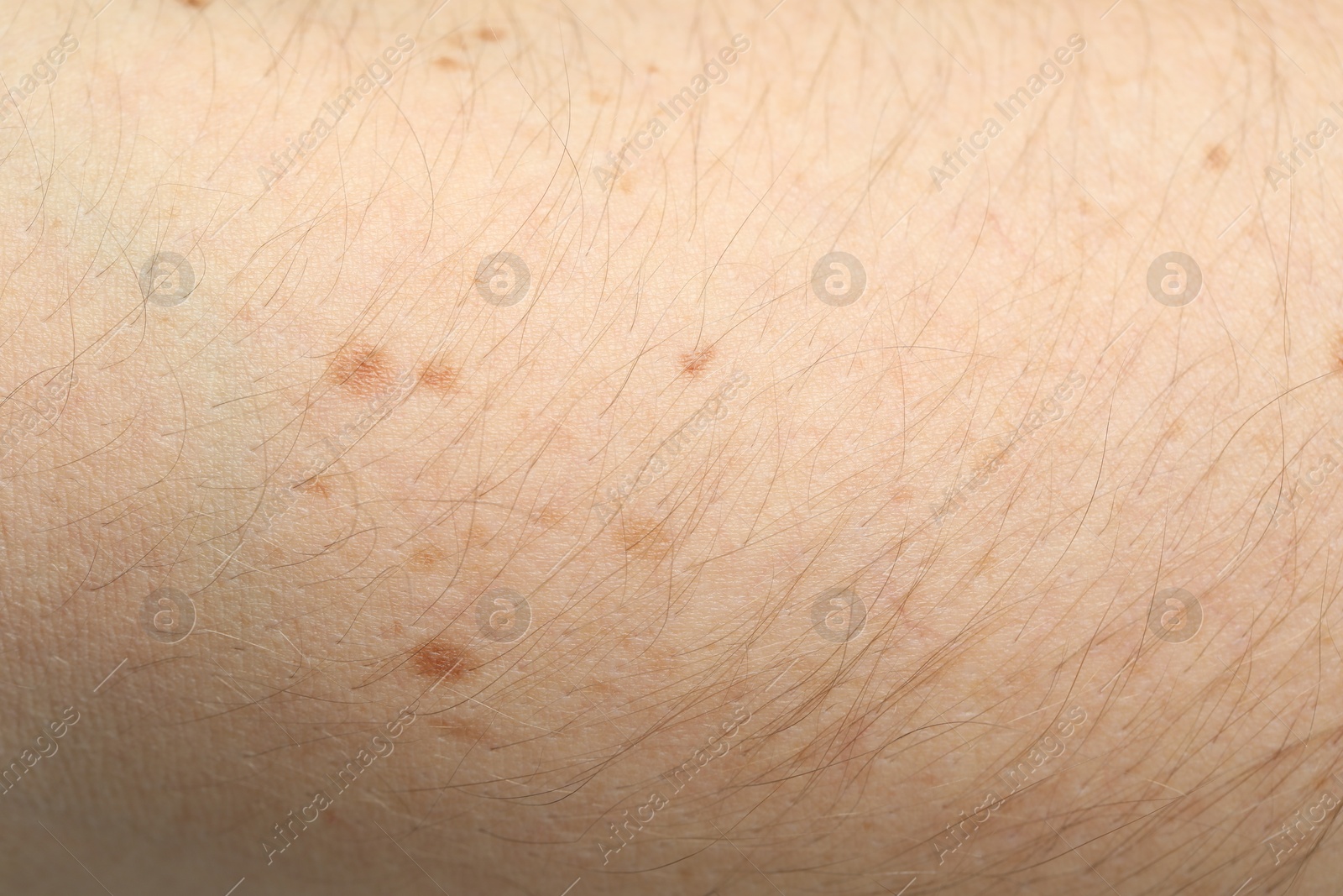 Photo of Texture of normal skin as background, closeup