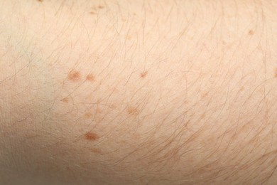 Photo of Texture of normal skin as background, closeup