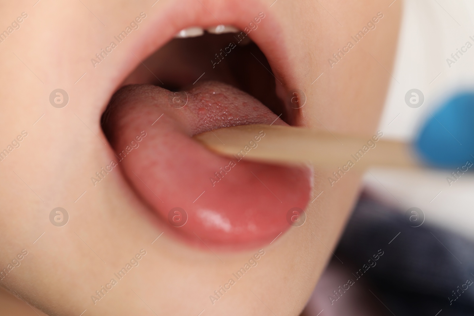 Photo of Examining girl's throat with tongue depressor, closeup