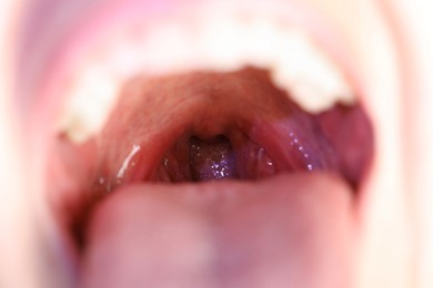 Photo of Closeup view of woman's oral cavity. Sore throat