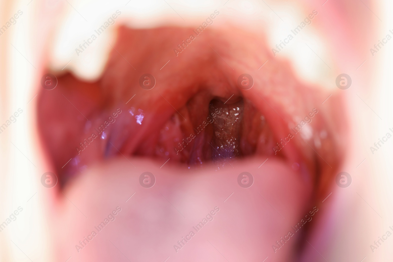 Photo of Closeup view of woman's oral cavity. Sore throat