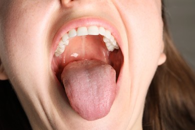 Photo of Closeup view of woman's oral cavity. Sore throat