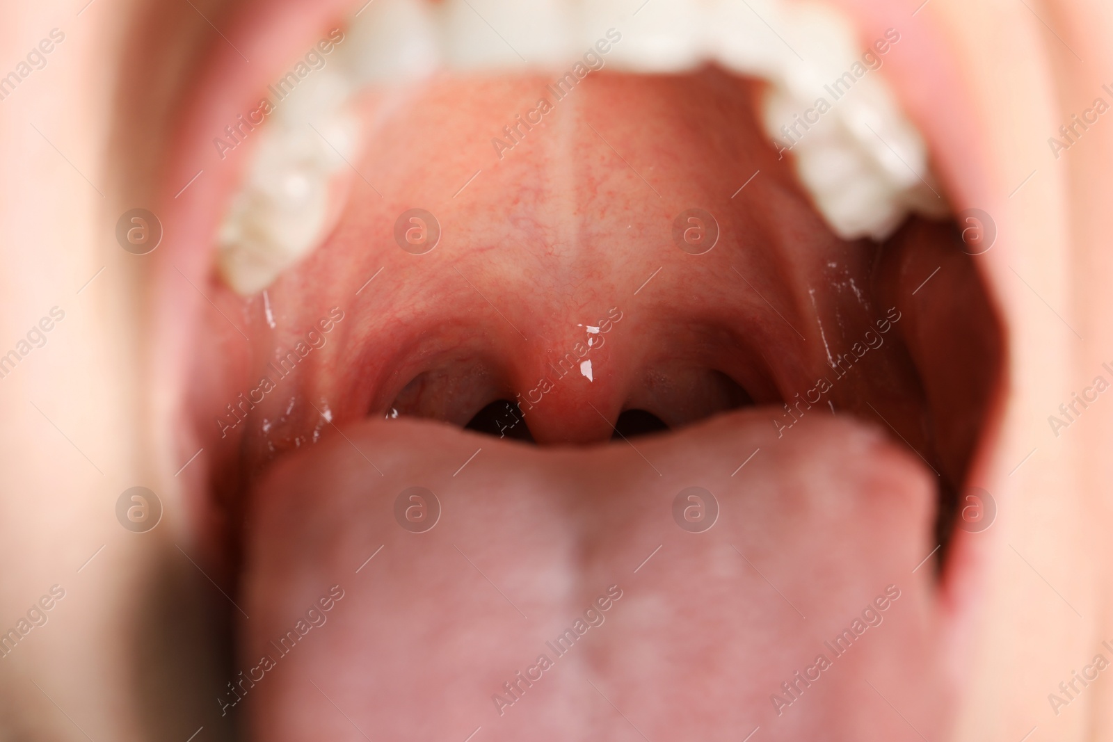 Photo of Closeup view of woman's oral cavity. Sore throat