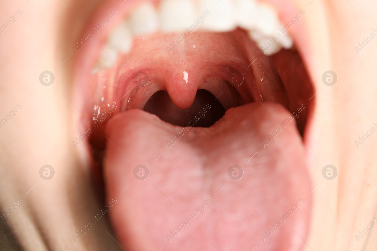 Photo of Closeup view of woman's oral cavity. Sore throat