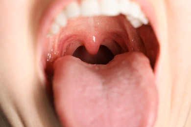 Photo of Closeup view of woman's oral cavity. Sore throat