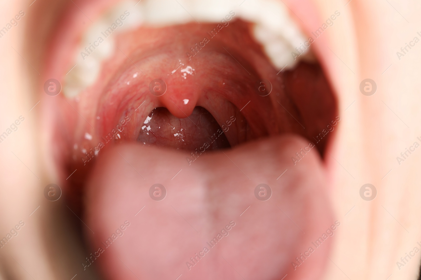 Photo of Closeup view of woman's oral cavity. Sore throat