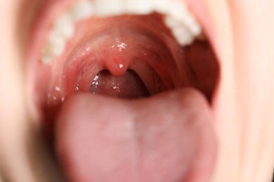 Photo of Closeup view of woman's oral cavity. Sore throat