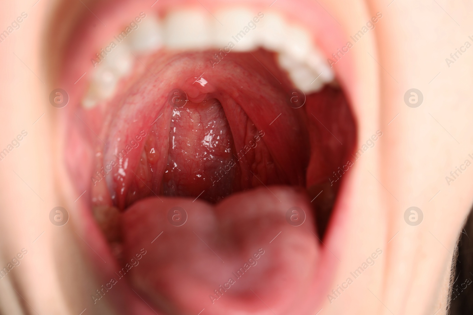 Photo of Closeup view of woman's oral cavity. Sore throat