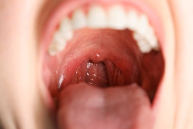 Closeup view of woman's oral cavity. Sore throat