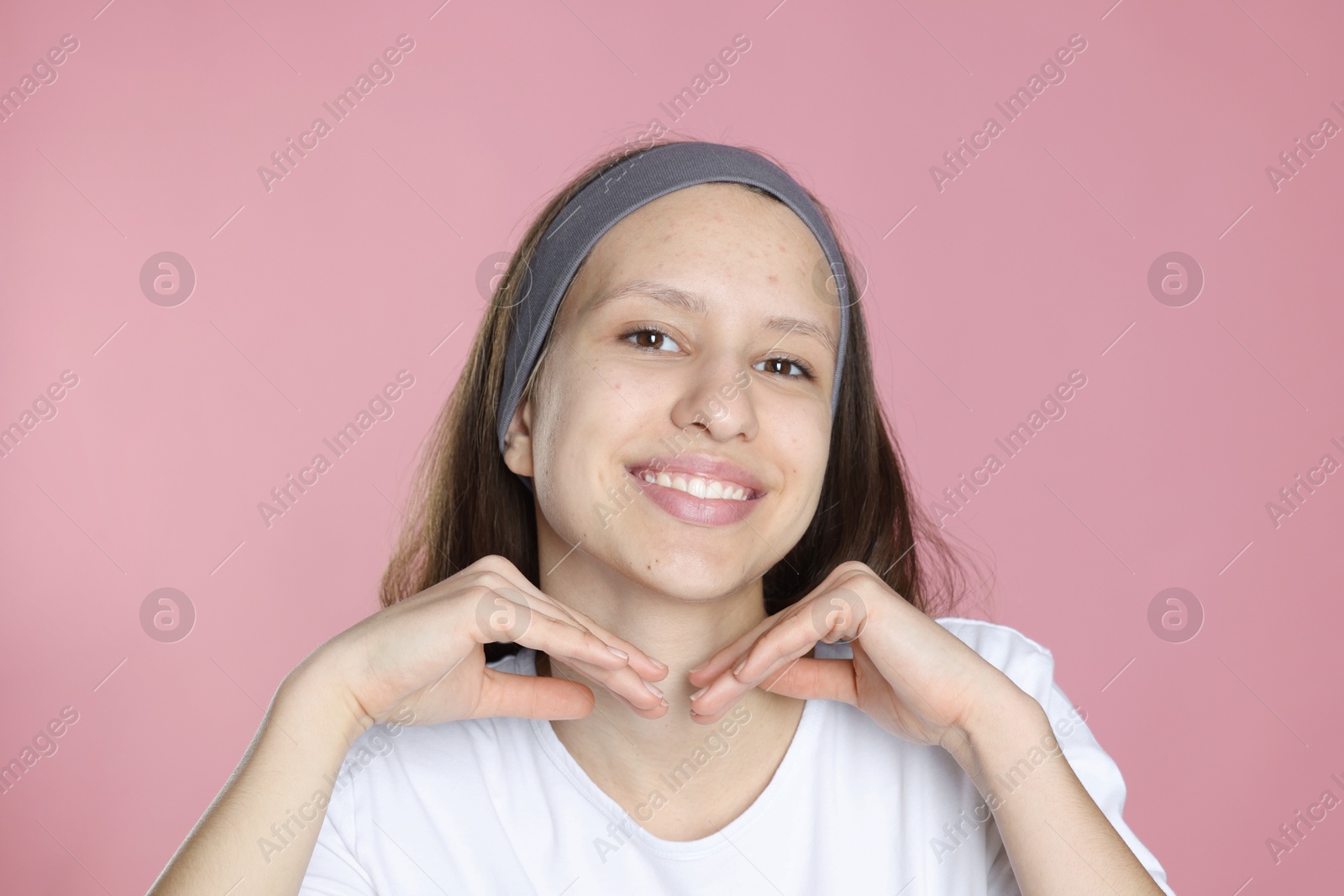 Photo of Teenage girl with acne problem on pink background