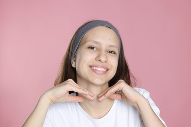 Photo of Teenage girl with acne problem on pink background