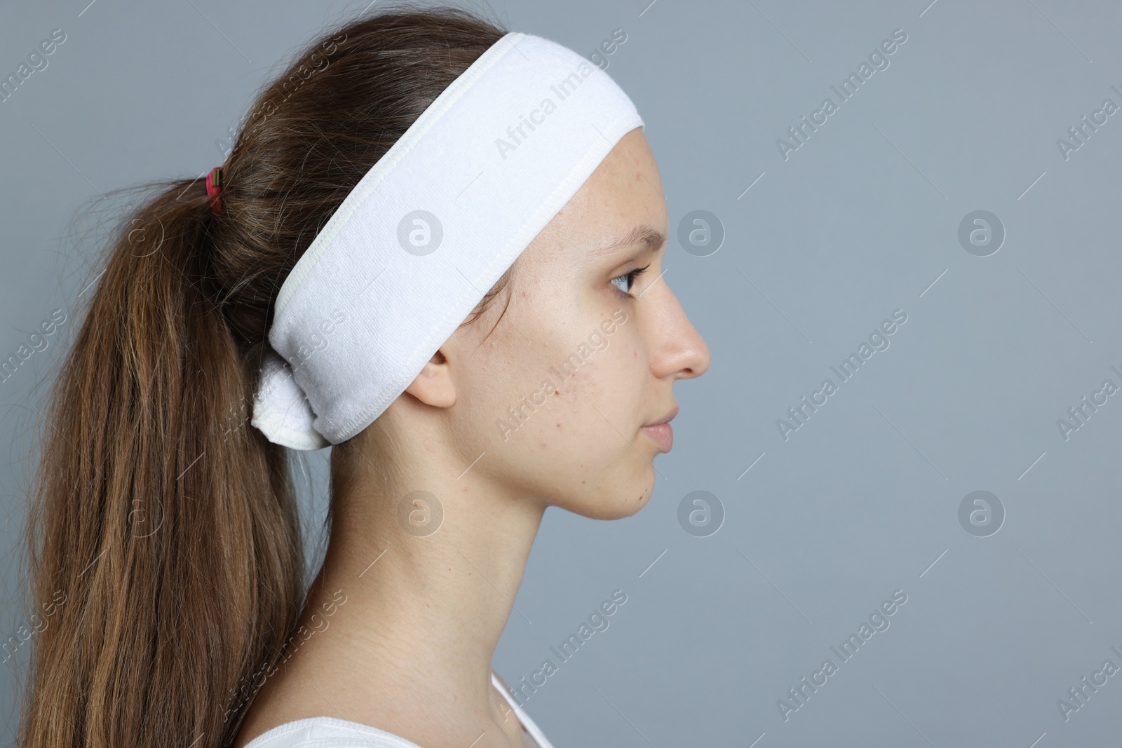 Photo of Teenage girl with acne problem on grey background. Space for text